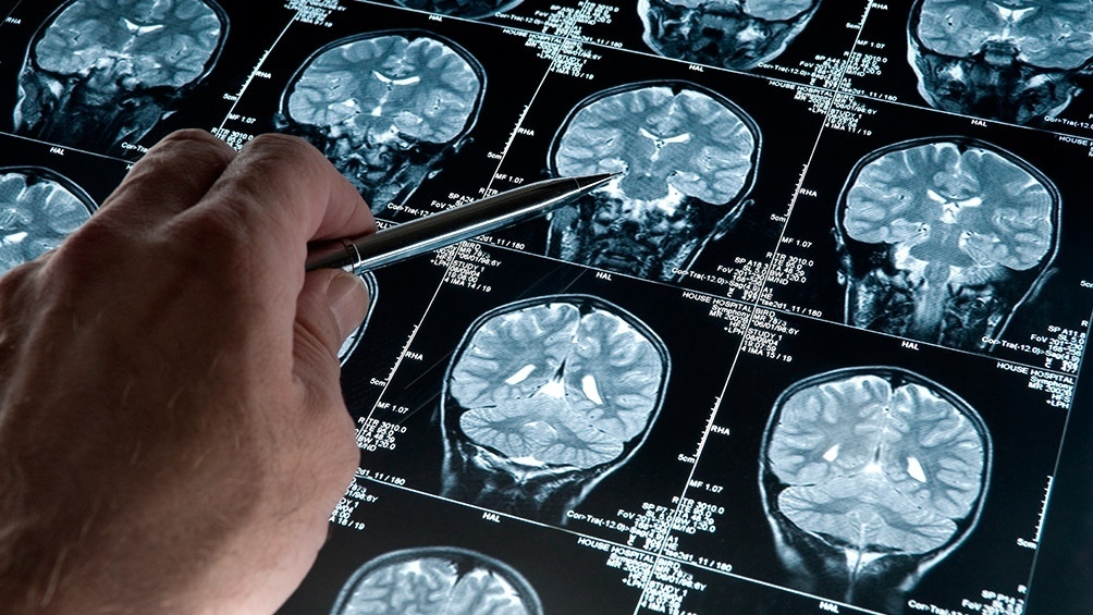 Imagen de El cerebro da "indicios" 20 a&ntilde;os antes