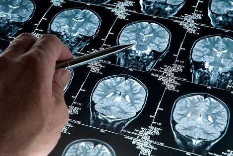 Imagen de El cerebro da "indicios" 20 a&ntilde;os antes