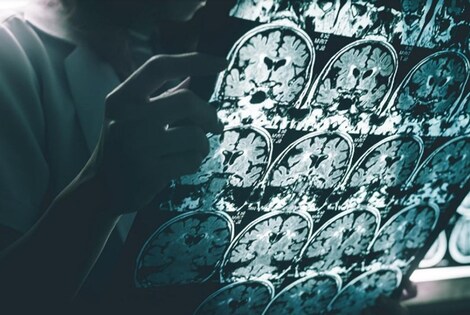 Imagen de Logran retrasar el Alzheimer en ratones