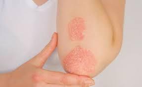 Imagen de Psoriasis: educaci&oacute;n y nuevos tratamientos, el camino para el control de la enfermedad