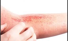 Imagen de 14 de septiembre D&iacute;a Mundial de la Dermatitis At&oacute;pica