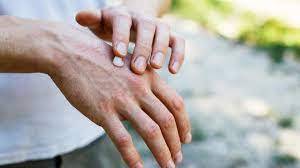 Imagen de Campa&ntilde;a nacional de educaci&oacute;n e informaci&oacute;n sobre psoriasis